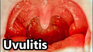 🔴 UVULITIS [upl. by Bigler]