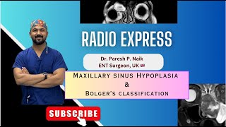 Maxillary sinus hypoplasia amp Bolger Classification [upl. by Assiralk]