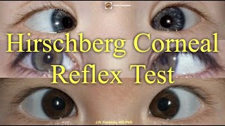 Hirschberg Corneal Reflex Test Principles and Procedure [upl. by Elyk653]