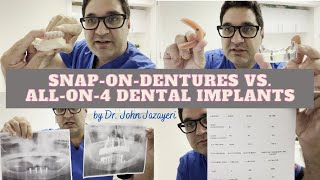 SnaponDentures vs Allon4 Implants Understanding The Difference Between The Two [upl. by Alleira]