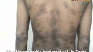 Psoriasis Vulgaris Spots on Face Forehead Chest Arms amp Back Treatment at Life Force [upl. by Berkeley]