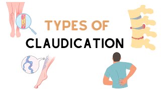 Types Of Claudication [upl. by Fi]