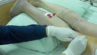 Popliteal Block Intertendinous Approach II [upl. by Rew521]