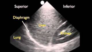 How To Ultrasound Detection of Pleural Fluid Case Study Video [upl. by Eaneg419]