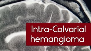 IntraCalvarial hemangioma on MRI scan  osseous venous lowflow vascular malformations mri [upl. by Chyou]