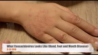 What Coxsackievirus Looks Like  Hand Foot and Mouth Disease [upl. by Placia]