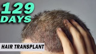 Fue Hair Transplant 129 Days post op Istanbul Turkey GROWTH STAGE [upl. by Bennie]