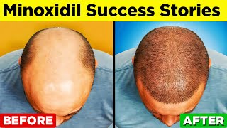 MINOXIDIL  A StepbyStep Guide to Regain Your Hair [upl. by Majka]