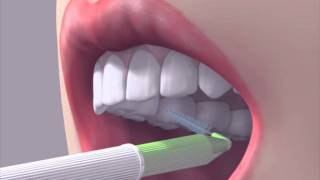 How to use an interdental brush [upl. by Merrick]