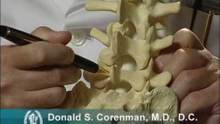 Isthmic Spondylolisthesis Video  Stress Fracture of the Back Vertebra  Spine Surgeon Colorado [upl. by Akimas]