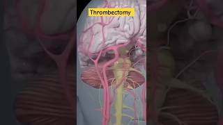 mechanical thrombectomy strokeanatomymedicalcareofHow [upl. by Ahsitil689]