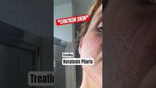 How to treat Keratosis Pilaris [upl. by Yerocal]