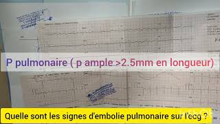 QUELLE SONT LES SIGNES DEMBOLIE PULMONAIRE SUR LECG CAS PRATIQUE [upl. by Petty]