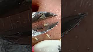 Skincare  Blackheads Removal 250 tweezers skincare blackheads blackheads [upl. by Aicenra180]