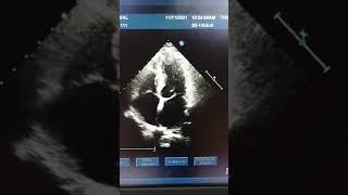 Mitral valve Myxomatous in 2d ECHO [upl. by Lotson604]