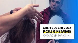 Greffe de cheveux femme sans rasage😮  Turkisme Medical [upl. by Aihseyk501]