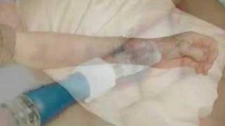 IV problem video from IVTEAM [upl. by Johnston]