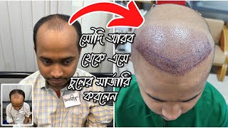 সৌদি আরব থেকে এসে বাসায় না গিয়ে আগে চুলের সার্জারি করলেন  Hair transplant Bangladesh [upl. by Lledniw]