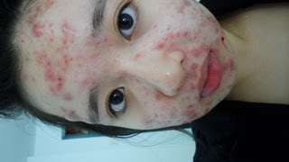 My Acne Story  Birth Control Pills For Accutane [upl. by Suolhcin]