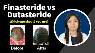 Finasteride vs Dutasteride Which is better  Finasteride and Dutasteride Side Effects [upl. by Suoiluj6]