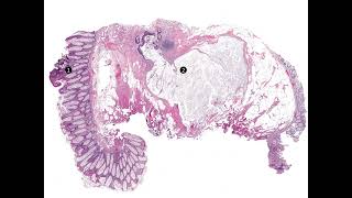 Adenomatous polyp with epithelial displacement forming a mucin pool at the polyp base [upl. by Senecal]