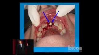 Learning from My Mistakes How to Drill Perfect Bicon Osteotomies Every Time [upl. by Waverley]