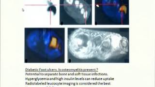 PET Scan in Orthopaedics [upl. by Suirtemed]