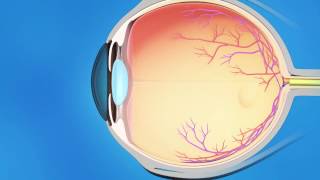 Laser Iridotomy for Glaucoma [upl. by Rego]