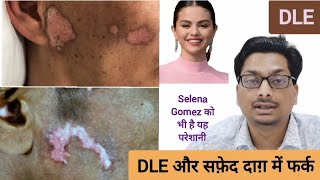 Discoid Lupus Erythematous  DLE और सफ़ेद दाग़ Vitiligo में फर्क  Selena Gomez को है यह परेशानी dle [upl. by Drofnats]