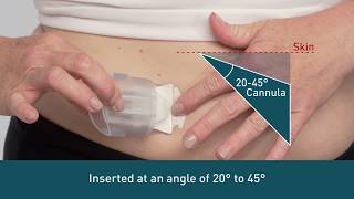 Infusion Sets for Beginners What Are Infusion Sets [upl. by Harrell521]