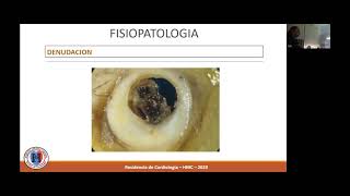 MODULO SÍNDROME CORONARIO AGUDO CON ELEVACIÓN DEL SEGMENTO ST DIAGNÓSTICO Y TRATAMIENTO PERCUTÁNEO [upl. by Seif]