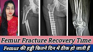 Femur Fracture Recovery Time  Femur Fracture Treatment fracturevlog [upl. by Flan]