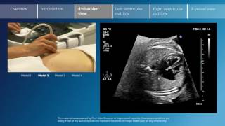 Key screening views of the fetal heart  Part 3  4chamber view [upl. by Lotsirk787]