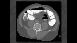 Small bowel disease  Ct enteroclysis [upl. by Attiuqram]