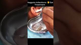 Myiasis of the ear is an infestation of the ear by maggots the larval stage of flies shorts [upl. by Windzer]