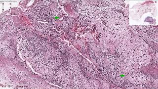 Osteosarcoma  Histopathology [upl. by Eillim]