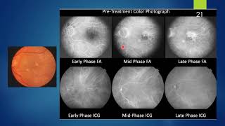 Polypoidal Choroidal Vasculopathy [upl. by Enois]