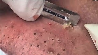 Satisfying Relaxing Acne Treatment  Blackhead Removal  E4 [upl. by Asyram]