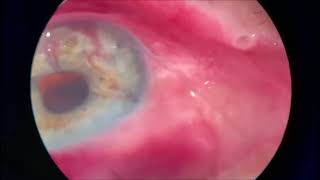 GATT is a Glaucoma MIGS procedure [upl. by Htiaf]