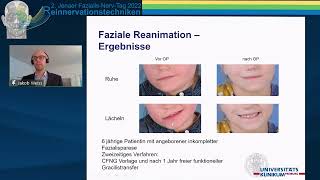 Präsentation der OPTechnik Crossface nerve graft und freie GracilisLappenplastik von Dr J Weiß [upl. by Aserej]