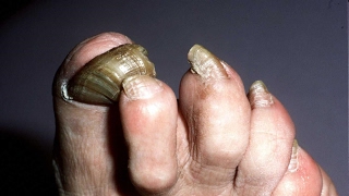 Toenail Fungus Cures That Work CAUTION Watch Till the End [upl. by Odoric]