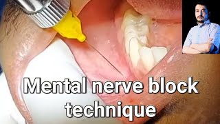 Local Anesthesia Mental Nerve block technique mandibular anesthesia Techniques dentistry [upl. by Darryn569]