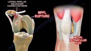 Basic Anatomy Of The Patella  Everything You Need To Know  Dr Nabil Ebraheim [upl. by Lindsay]