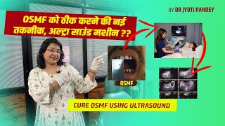 OSMF को ठीक करने की नई तकनीक अल्ट्रा साउंड मशीन ultrasound [upl. by Thomey]