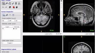 Registering stroke lesions to template space using LESYMAP [upl. by Ardiedal818]