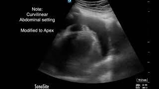 POCUS guided Pericardiocentesis An Intuitive Approach [upl. by Hamford]