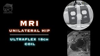 MRI – UNILATERAL HIP [upl. by Oniger944]