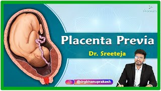 Placenta Previa Etiology Pathophysiology Clinical presentation Diagnosis and Treatment [upl. by Nosyrb]