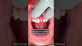 2 front teeth  porcelain crowns  dental crowns before and after  Dr Yazdan  smile makeover [upl. by Jessika]