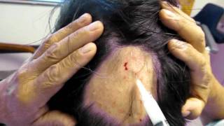 alopecia areata injections [upl. by So]